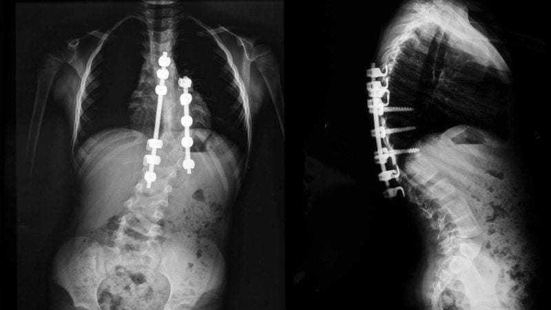 X-ray images showing spinal rods and screws used in scoliosis correction surgery.